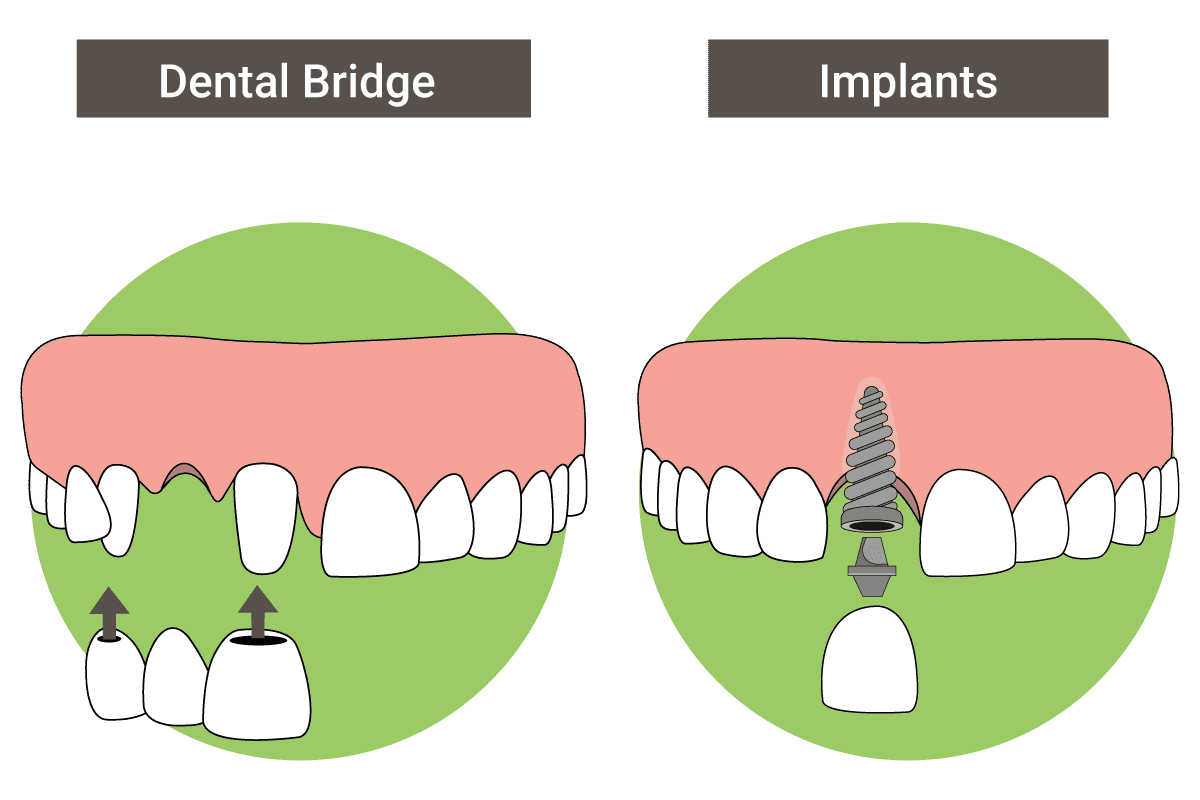 bridges and implants