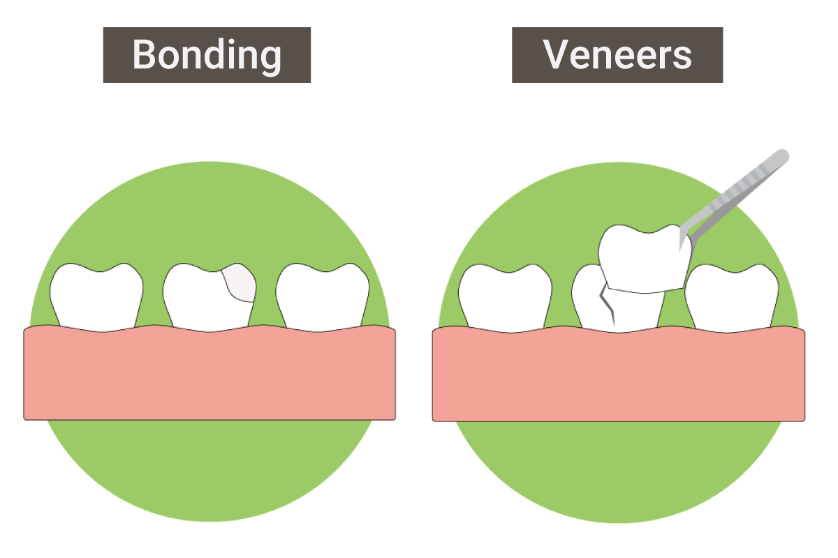 Broken Teeth Treatment Options