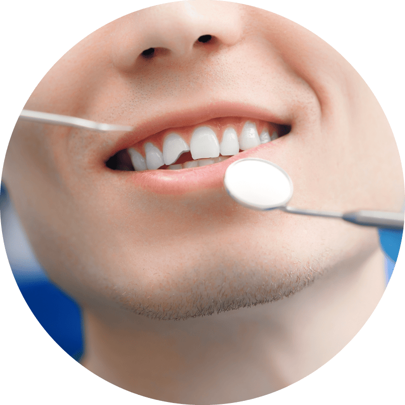 Cracked Tooth