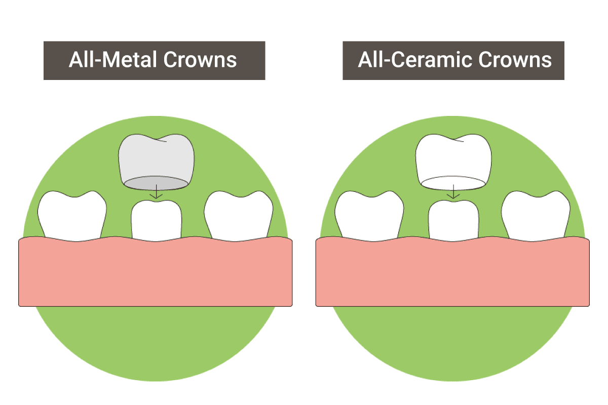 Crowns Treatment Options