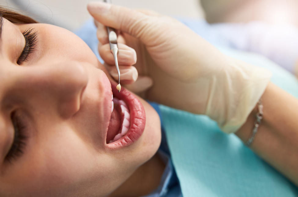 Fillings - How It Works?