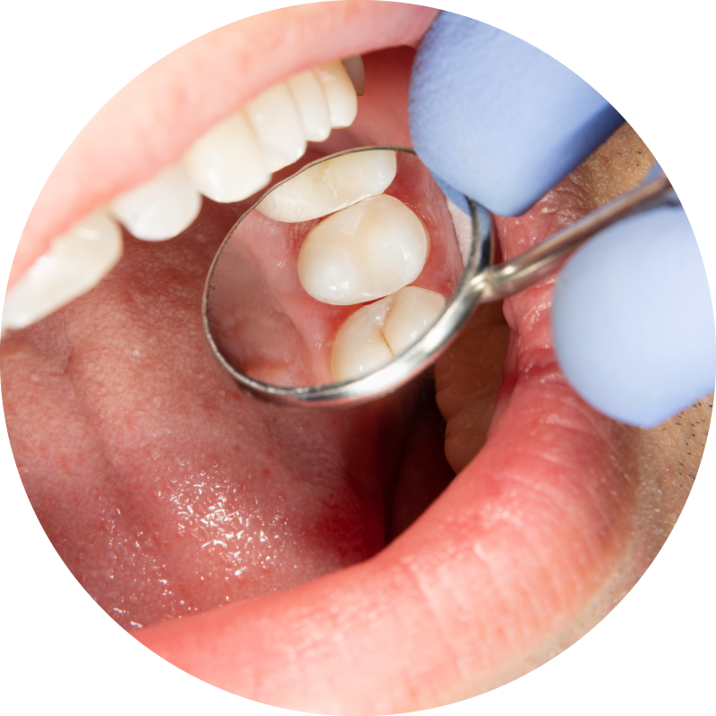 Fillings