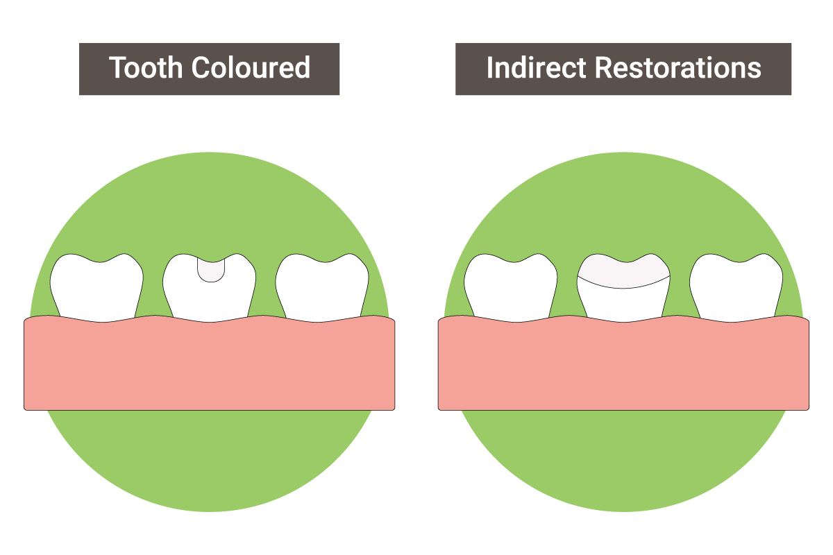 Tooth-coloured (composite) fillings