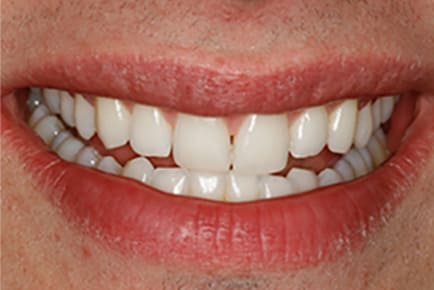 White Front Teeth Bonding - After Treatment