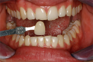  White Front Teeth Bonding - Before Treatment