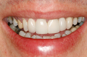 Spot The Cosmetic Bridge - After Treatment