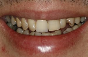 Spot The Cosmetic Bridge- Before Treatment