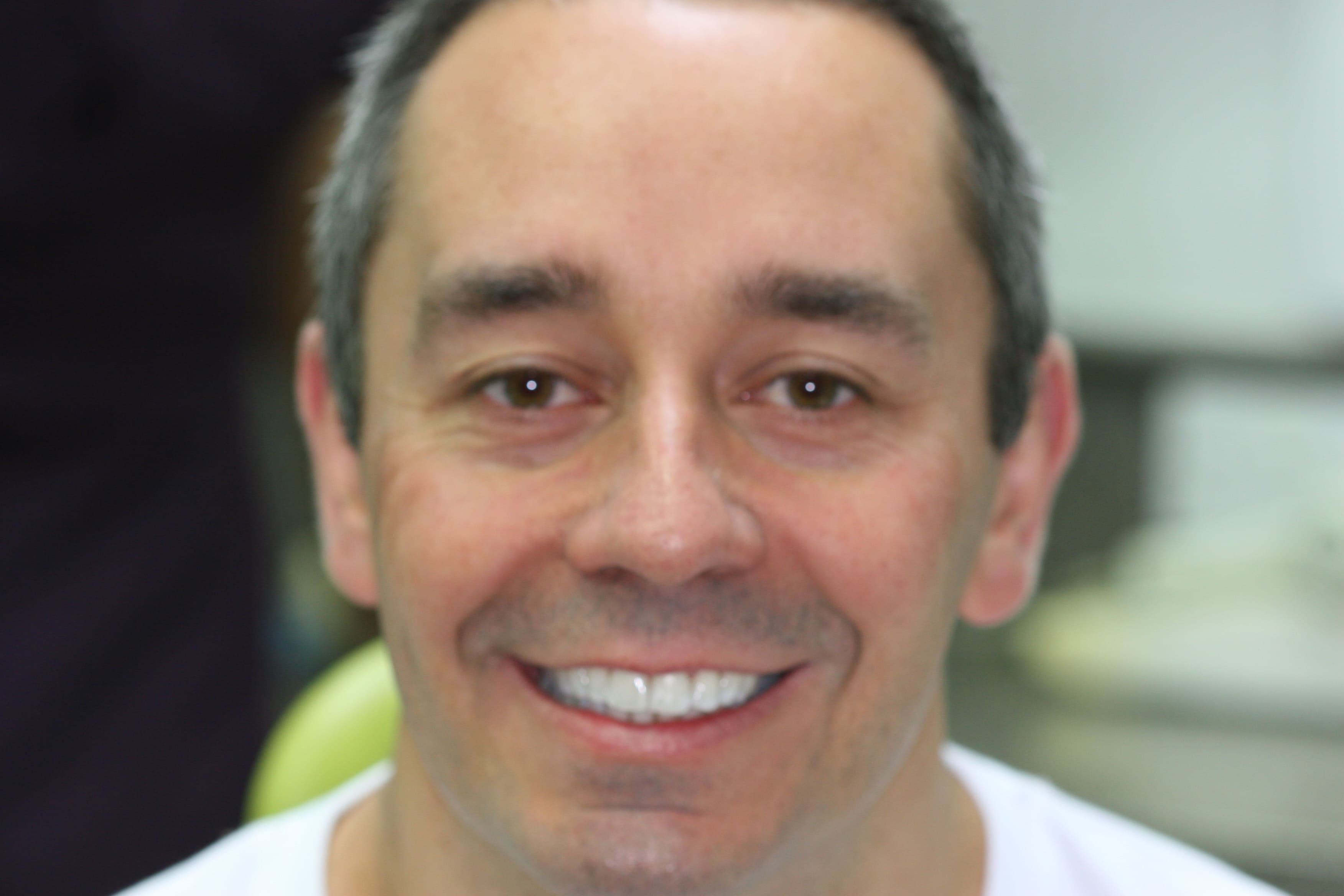 Six Month Smile - After Treatment