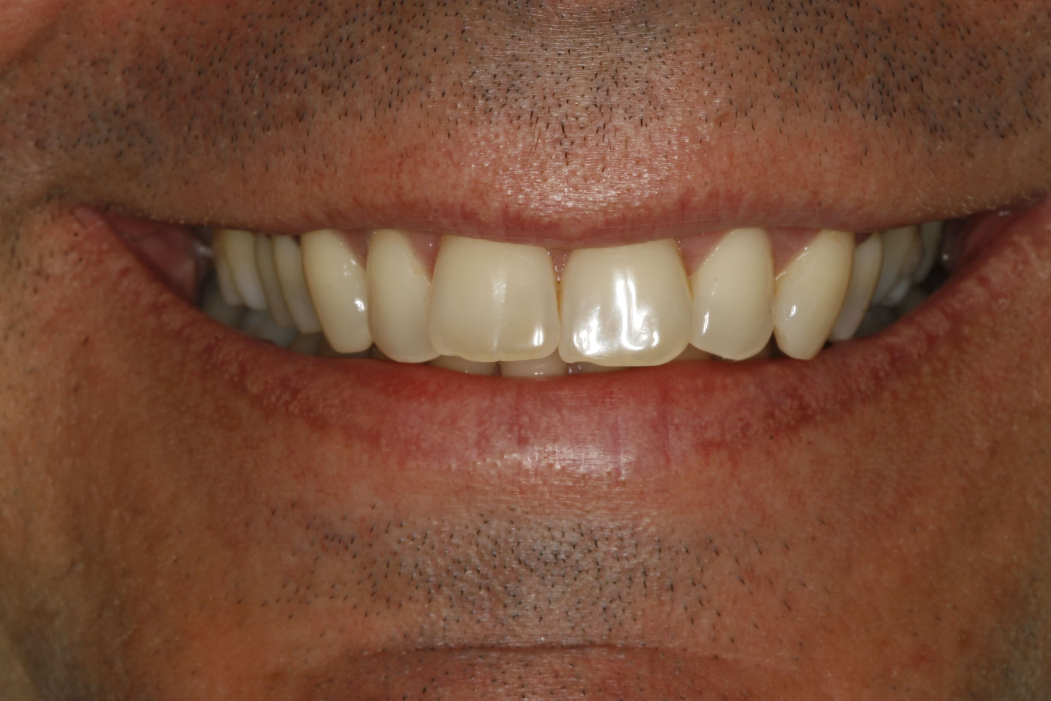Six Month Smile - Before Treatment
