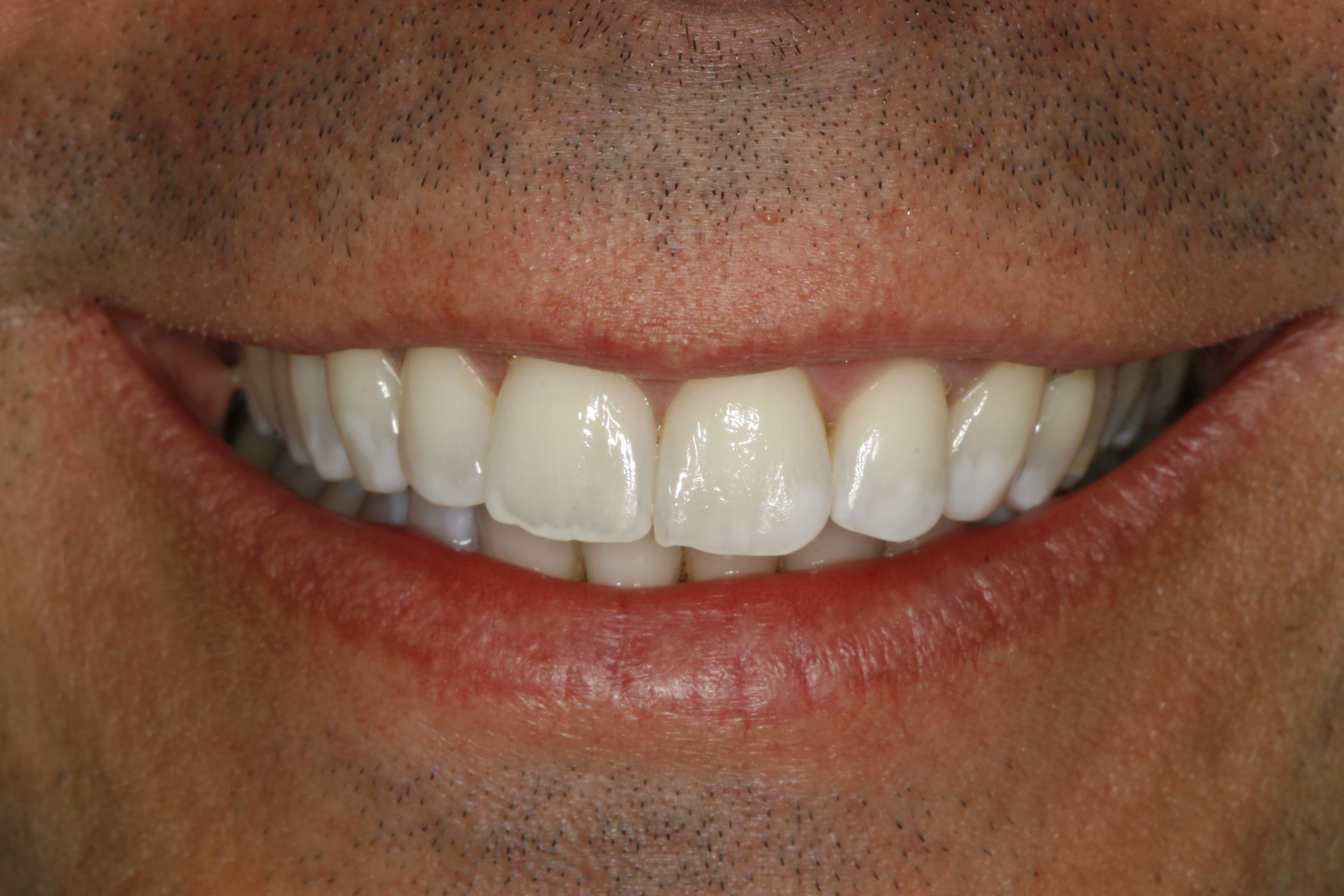Six Month Smile - After Treatment