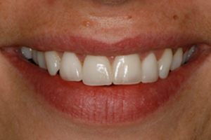 Teeth Whitening - After Treatment