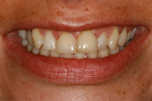 Teeth Whitening - Before Treatment