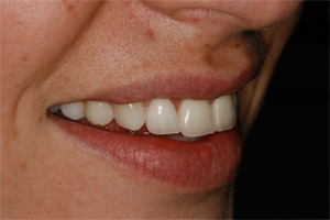 Teeth Whitening - After Treatment