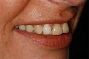 Teeth Whitening - Before Treatment