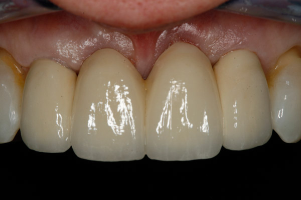 Unhappy Appearance - After Treatment