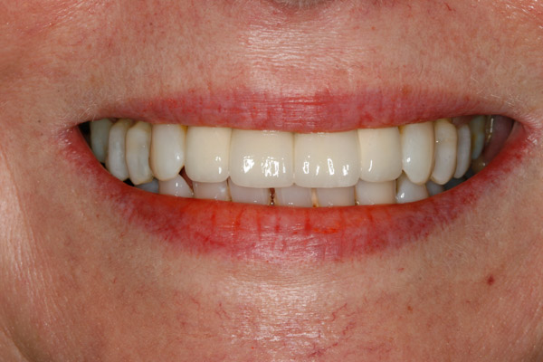 Unhappy Appearance - After Treatment