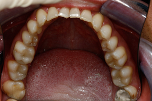 Secret Unseen Fillings - After Treatment