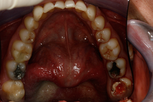 Secret Unseen Fillings - Before Treatment