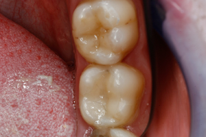 Secret Unseen Fillings - After Treatment