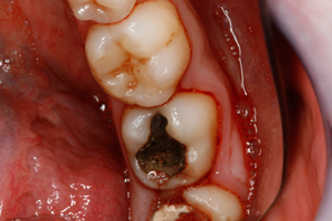 Secret Unseen Fillings - Before Treatment