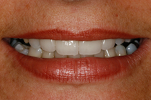 Cosmetic Veneers & Whitening - After Treatment