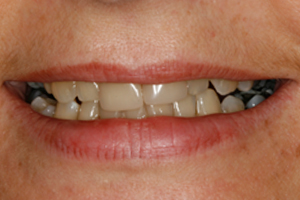 Cosmetic Veneers & Whitening - Before Treatment