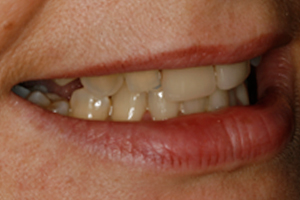 Cosmetic Veneers & Whitening - Before Treatment