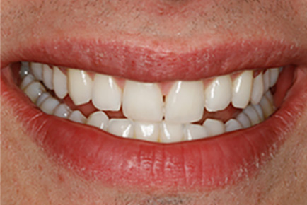 AFTER Teeth Whitening Composite Build up