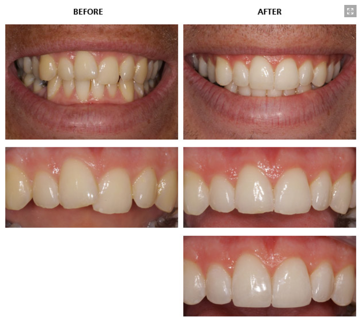 Inman_Aligner_Before_and_After