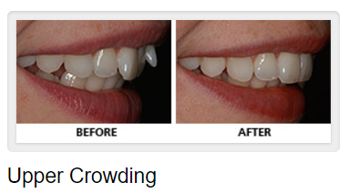Upper Teeth Crowding