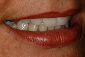 AFTER - Cosmetic Veneers Right